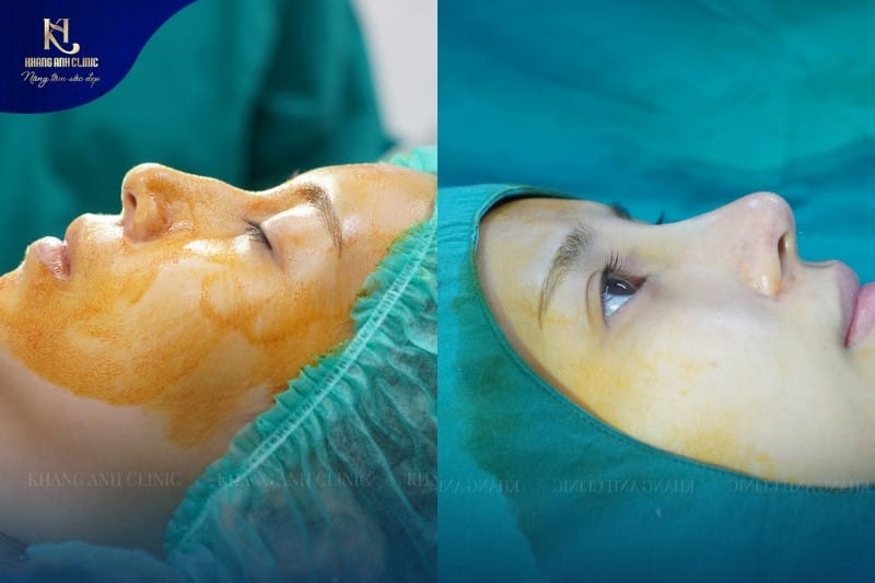 Quy trình thực hiện chỉnh hình mũi gồ đảm bảo quy trình vô trùng, an toàn