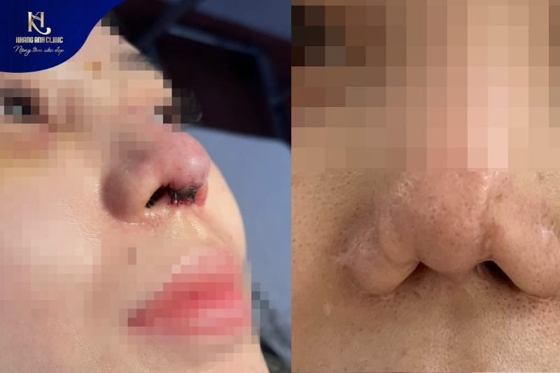 Chỉnh hình mũi gồ có thể phát sinh các biến chứng do quy trình không đảm bảo yếu tố vô trùng