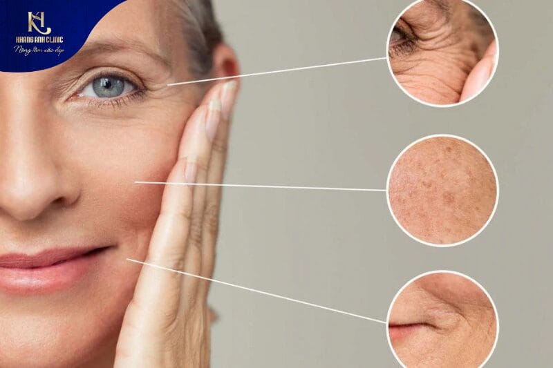 Nâng cơ bằng công nghệ sóng RF phù hợp với chị em có tình trạng da chùng nhão, chảy xệ