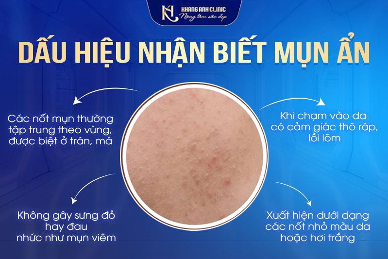 Những dấu hiệu và triệu chứng của mụn ẩn bạn cần biết