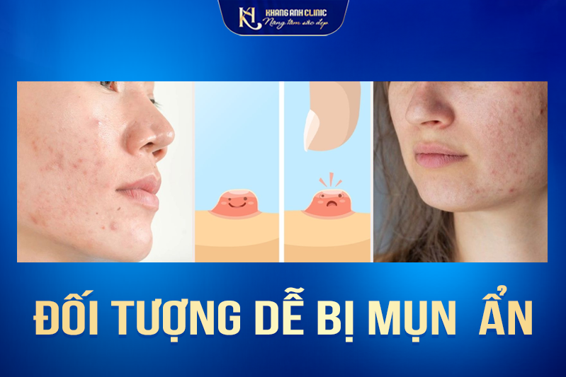 Những ai có nguy cơ mắc phải mụn ẩn