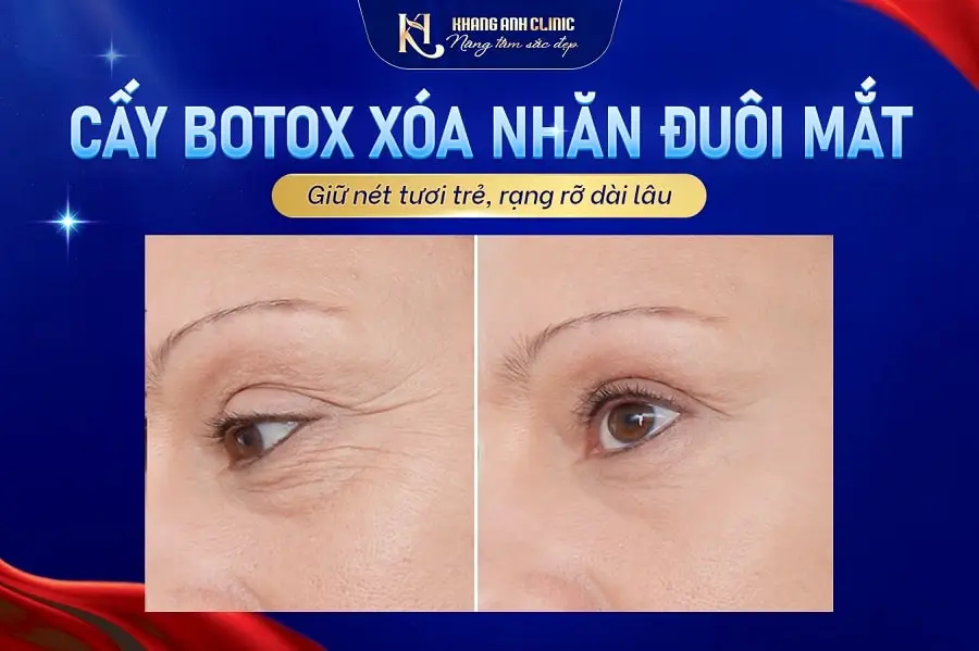 Hiệu quả cấy botox xóa nhăn đuôi mắt