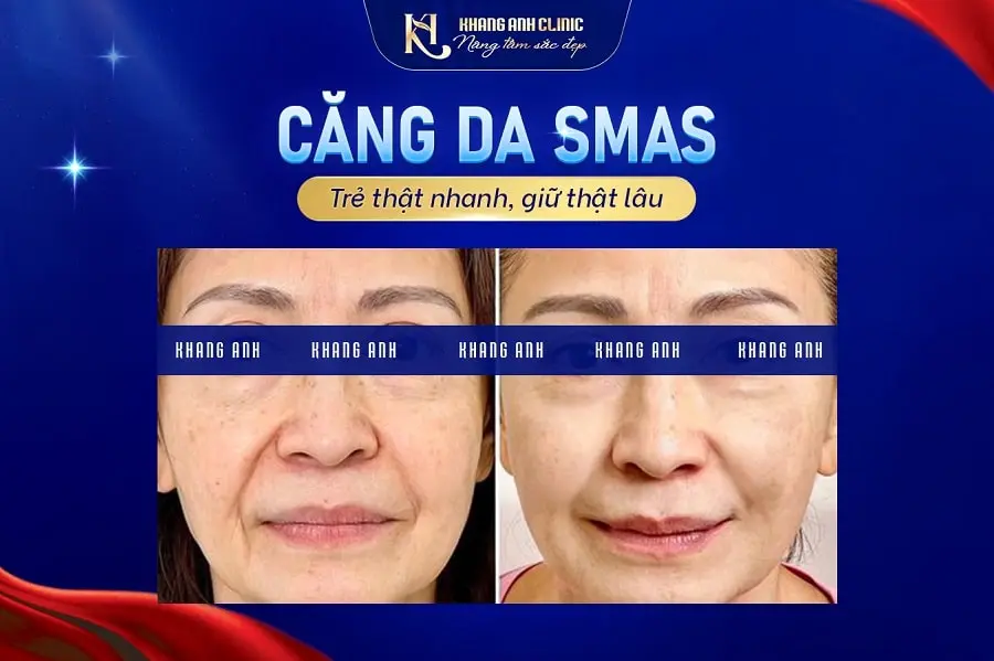 Hiệu quả khi căng da mặt SMAS
