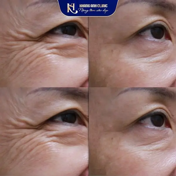 Khách số 1 trước và sau khi cấy botox xóa nhăn đuôi mắt ở Khang Anh