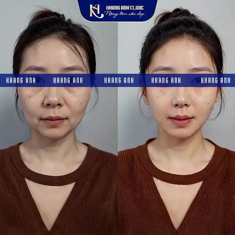Hình ảnh Khách số 1 trước và sau cấy PRP tại phòng khám Khang Anh
