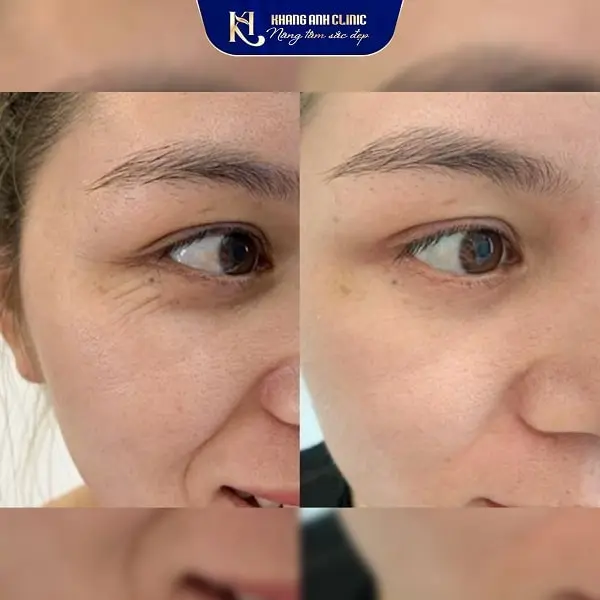 Khách số 2 trước và sau khi cấy botox xóa nhăn đuôi mắt ở Khang Anh