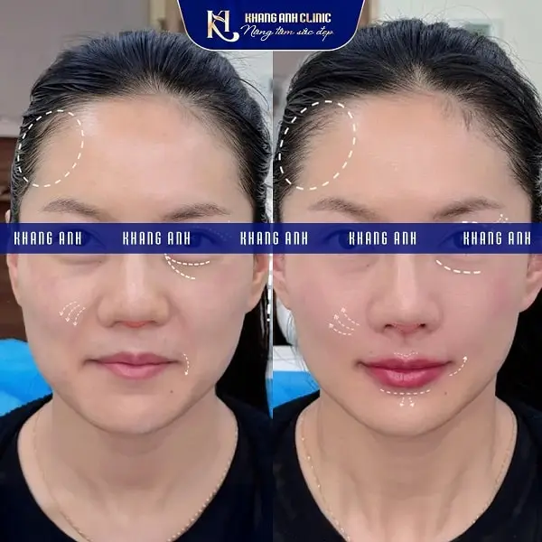 Khách số 2 trước và sau khi căng da mặt toàn phần SMAS tại Khang Anh