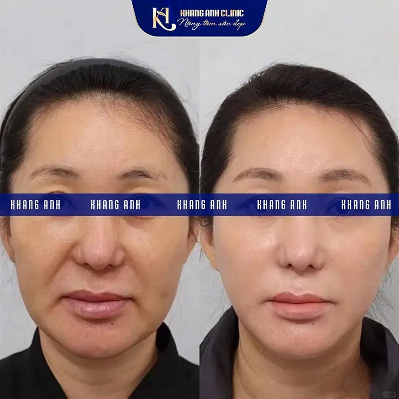 Hình ảnh Khách số 2 trước và sau cấy PRP tại phòng khám Khang Anh