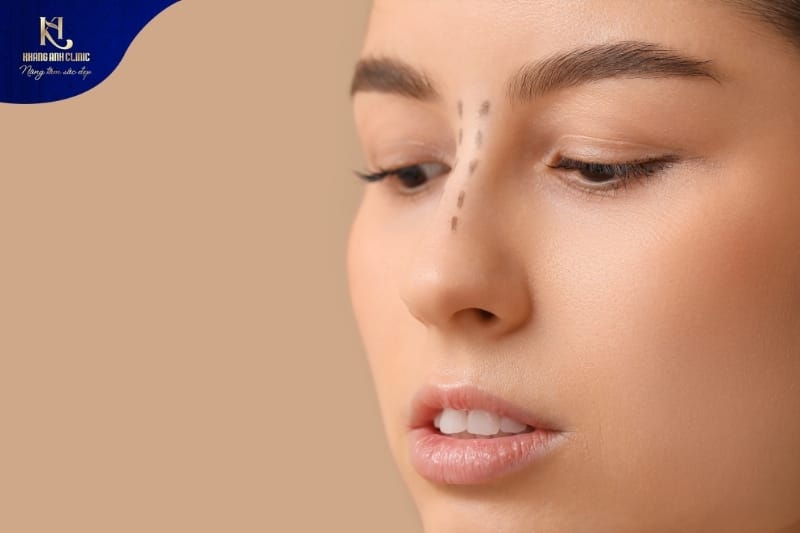 Nâng mũi sụn Surgiform phù hợp người có da mỏng, sức khỏe yếu