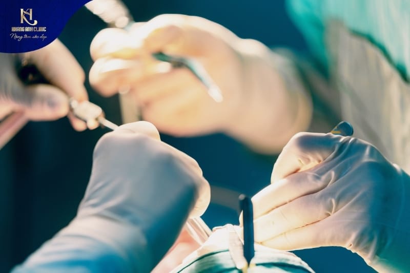 Quy trình nâng mũi bằng sụn surgiform đảm bảo chuẩn Y khoa nhằm đảm bảo an toàn