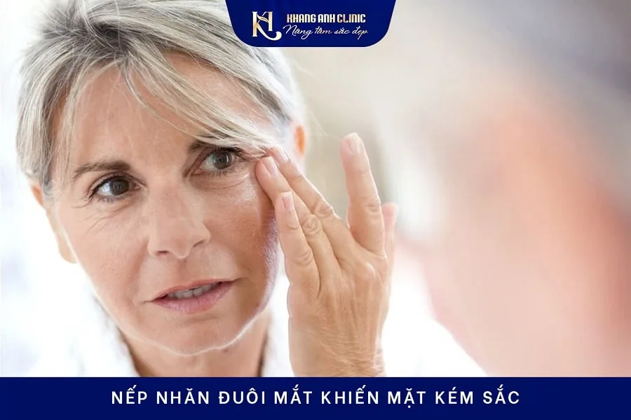 Da mặt lão hóa xuất hiện nhiều nếp nhăn đuôi mắt