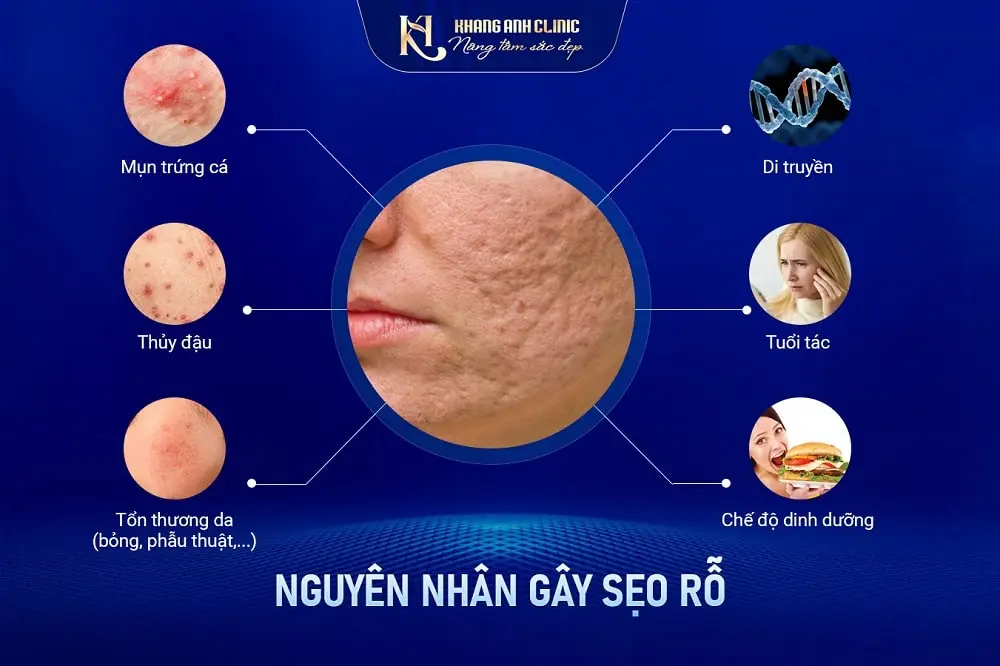 Nguyên nhân gây sẹo rỗ