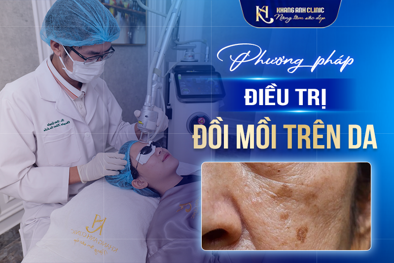 Các phương pháp điều trị đồi mồi trên da phổ biến hiện nay