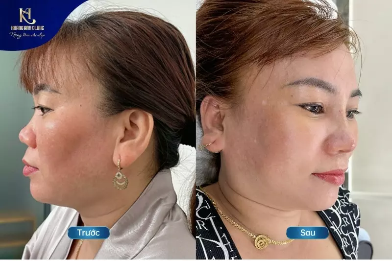 Kết quả sau tạo hình mũi tạo phòng khám thẩm mỹ Khang Anh