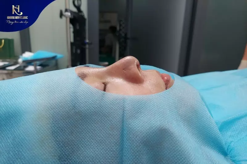 Tại Khanh Anh cánh mũi lệch được chỉnh sửa với quy trình chuẩn Y khoa, đảm bảo an toàn