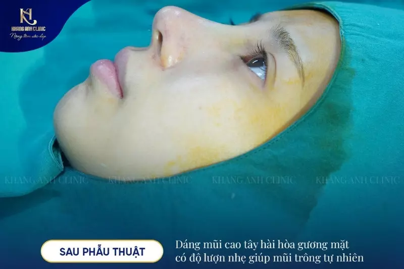 Tại Khang Anh quy trình tạo hình dáng mũi lệch được thực hiện trực tiếp bởi bác sĩ chuyên khoa thẩm mỹ