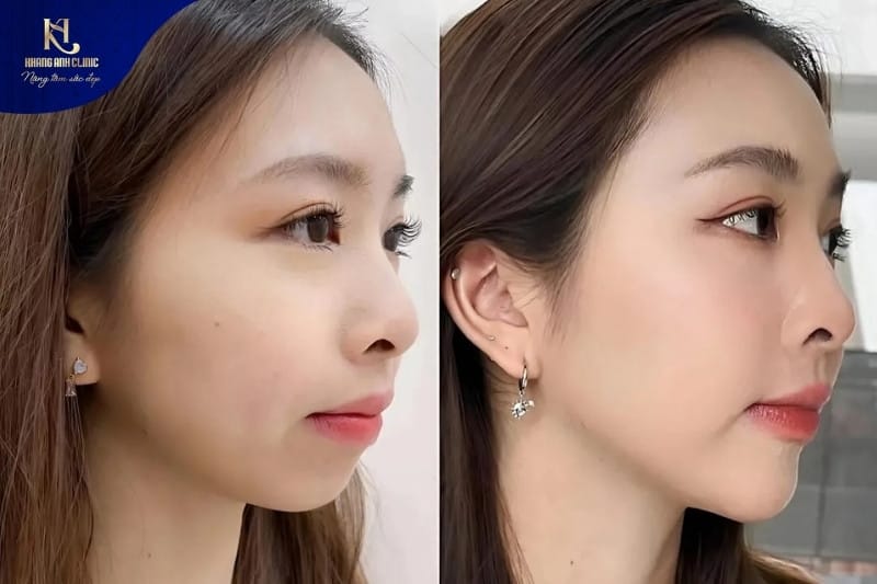 Kết quả sau khi thu gọn cánh mũi tại Khang Anh