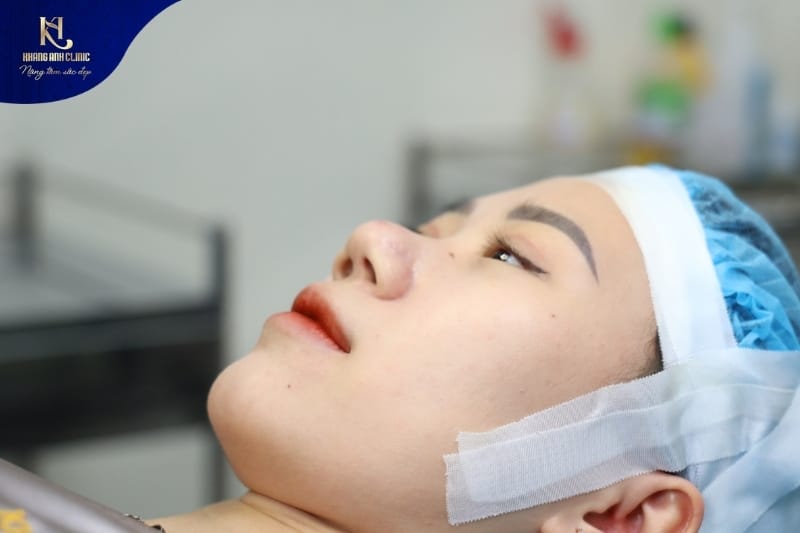 Thu gọn cánh mũi là phương pháp chỉnh hình cánh mũi thẩm mỹ