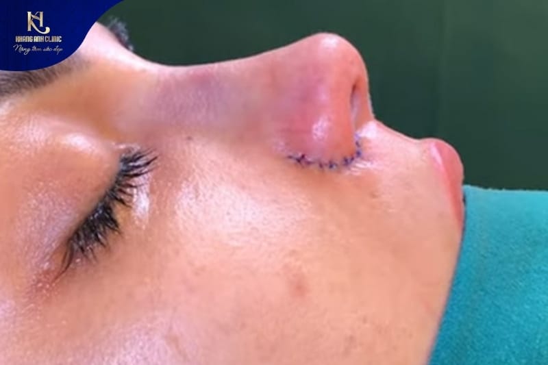 Kỹ thuật cuộn cánh mũi dành cho cánh mũi mỏng, không quá bè ngang