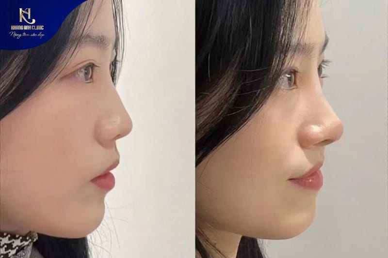 Một số hình ảnh trước và sau khi thu gọn cánh mũi tại Khang Anh
