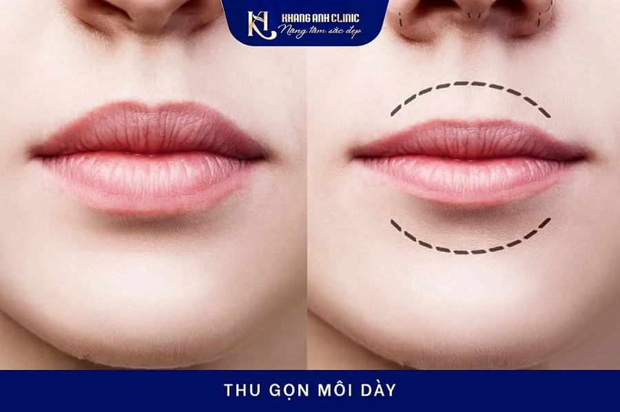 Thu gọn môi dày