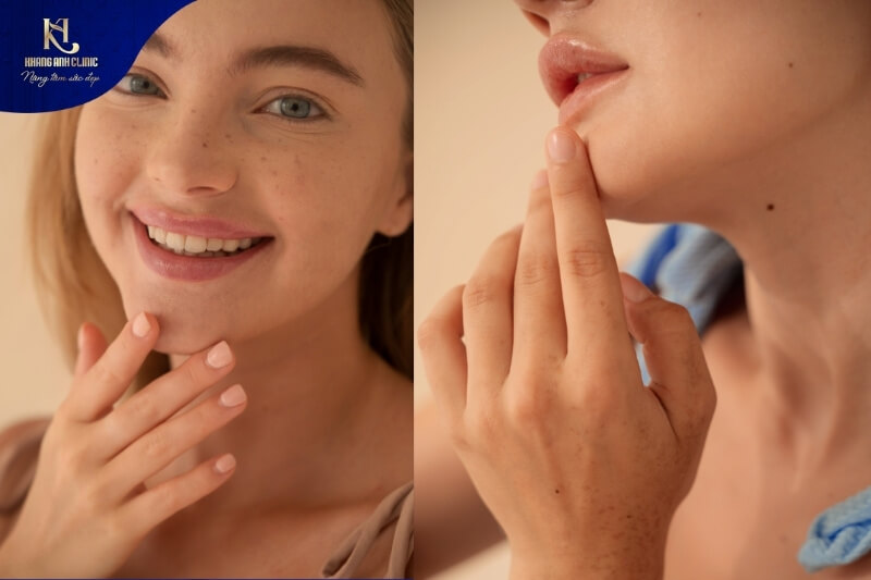 Tiêm định hình cằm được bác sĩ tại Khang Anh khuyên dùng để cải thiện tình trạng cằm ngắn, cằm lẹm