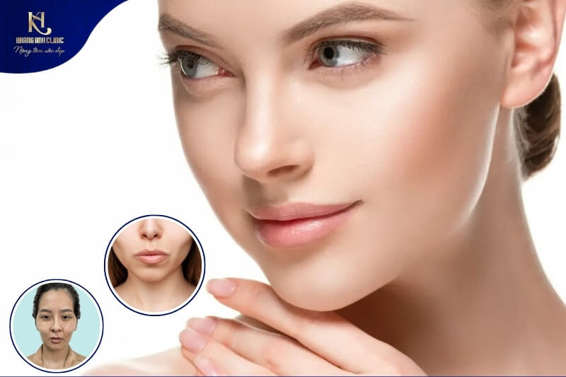 Má hóp là vùng má bị trũng sâu, rõ rệt