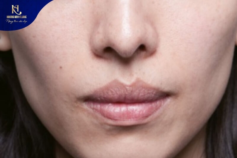 Tiêm HA làm đầy má hóp phù hợp với chị em có vùng má bị lão hóa, thiếu sức sống