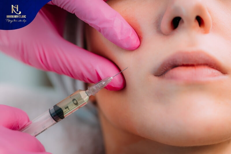 Cấy HA làm đầy má hóp tại Khang Anh đảm bảo an toàn đạt chuẩn FDA
