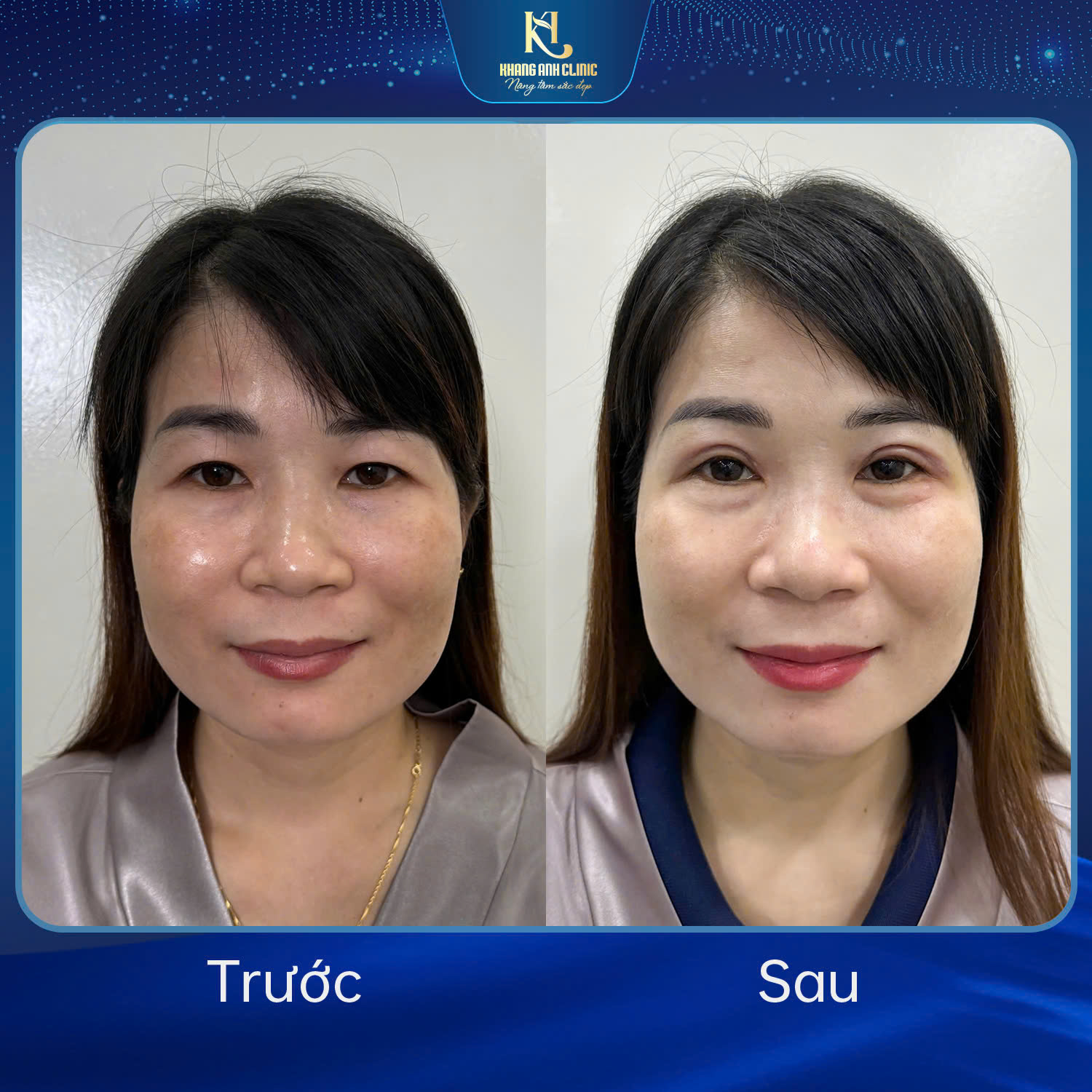 Kỹ thuật cắt mí di chuyển túi mỡ tại Khang Anh có hiệu quả lâu dài