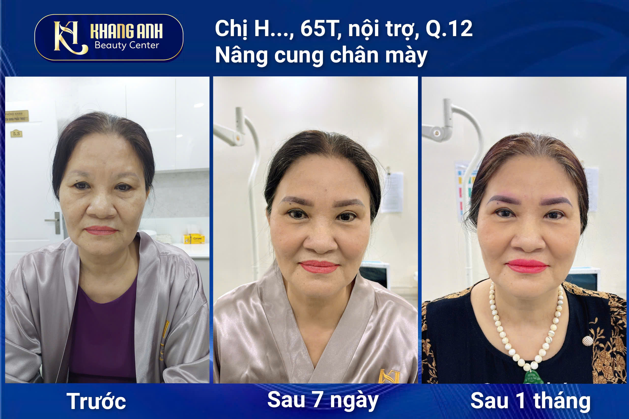 Khách hàng sau khi cắt mí và di chuyển túi mỡ tại Khang Anh
