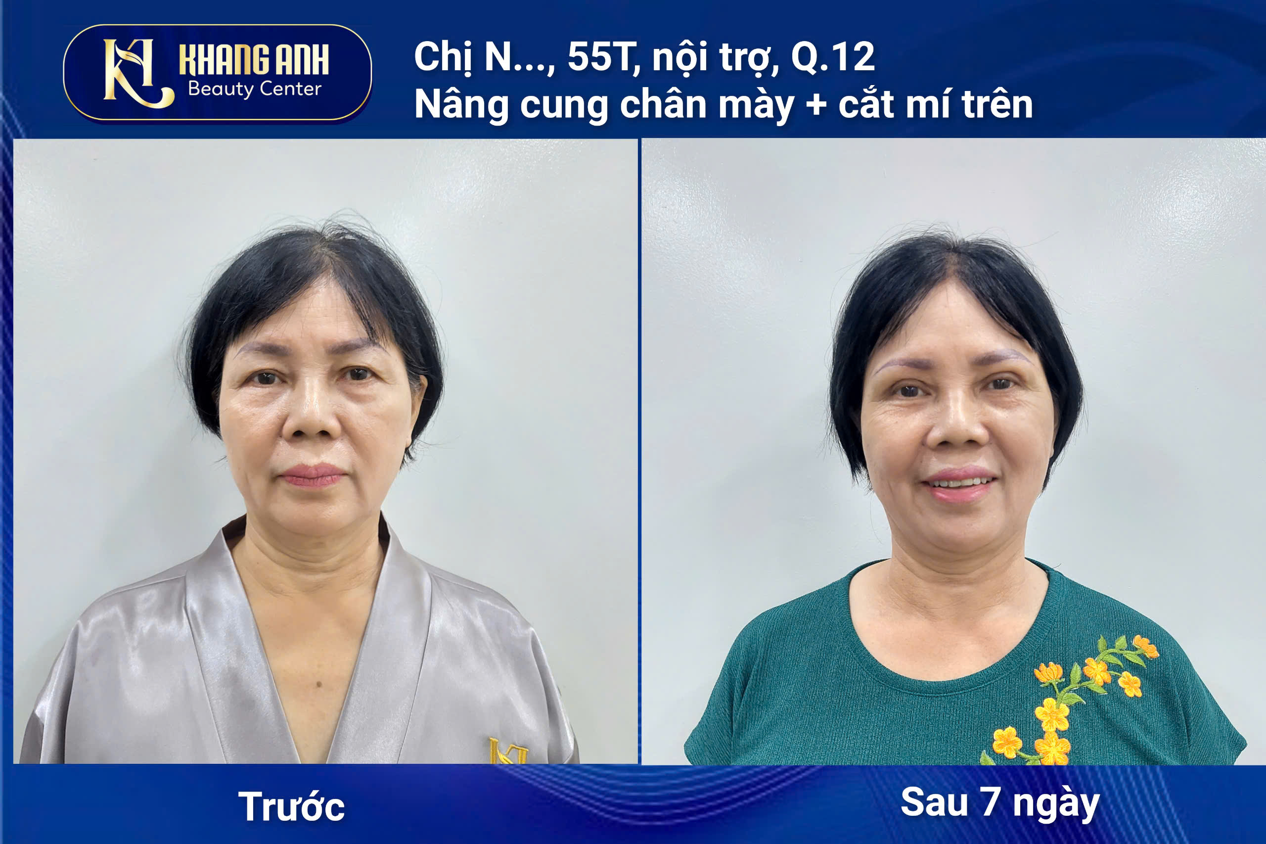 Đôi mắt to tròn, tự nhiên hơn sau khi cắt mí di chuyển túi mỡ