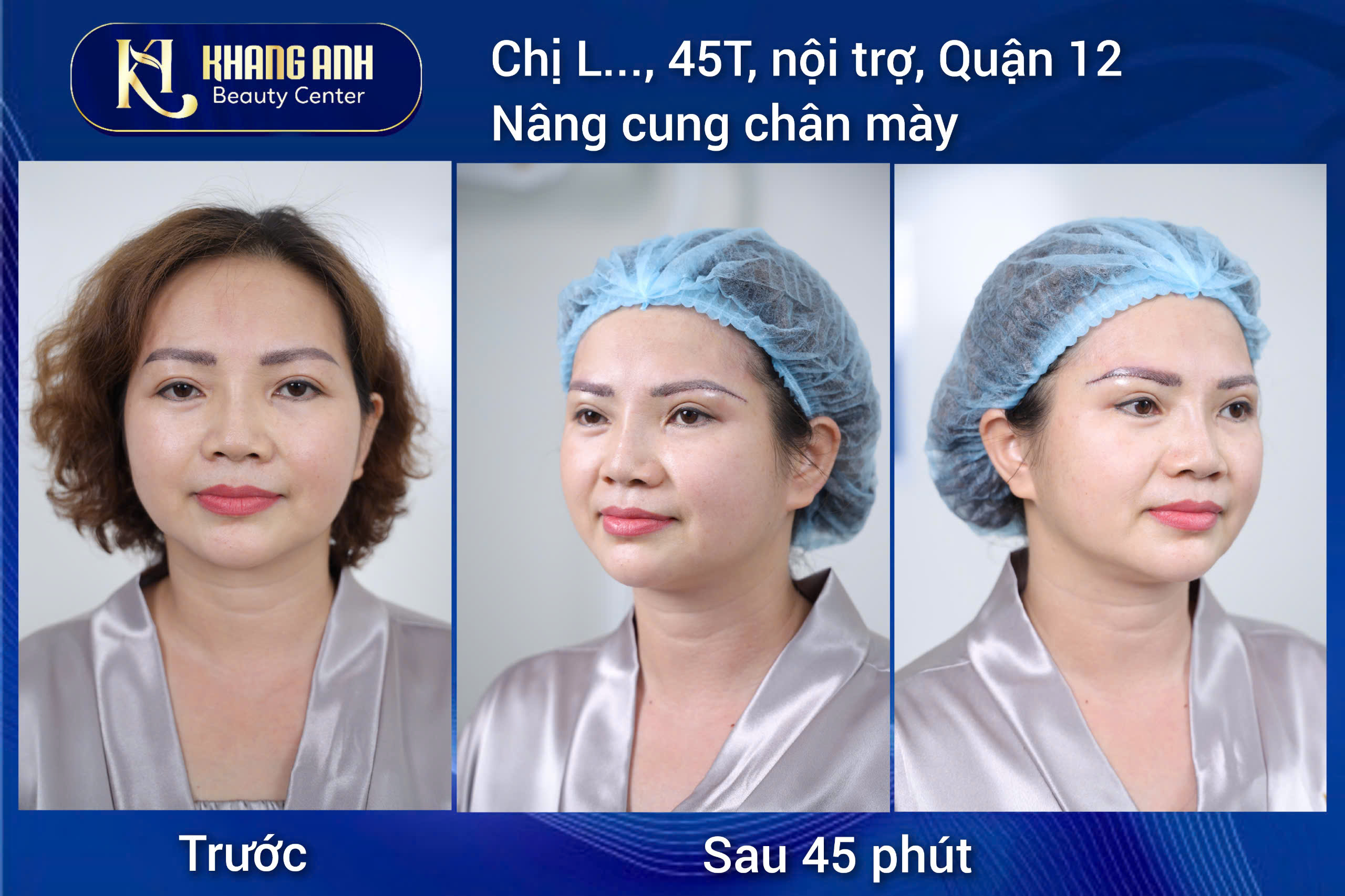 Cắt mí di chuyển túi mỡ tạo hiệu ứng mí mắt cân đều