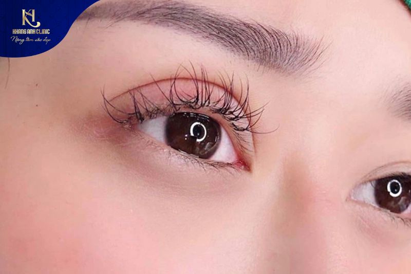 Chăm sóc sau hậu phẫu cắt mí mắt cần tuân thủ hướng dẫn của bác sĩ