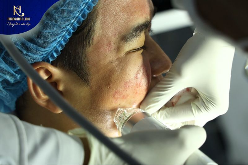 Điều trị mụn đúng cách giúp tăng hiệu quả, đảm bảo an toàn cho da