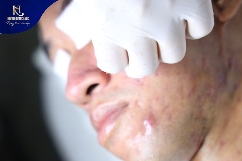 Lấy nhân mụn là liệu pháp điều trị mụn hiệu quả 