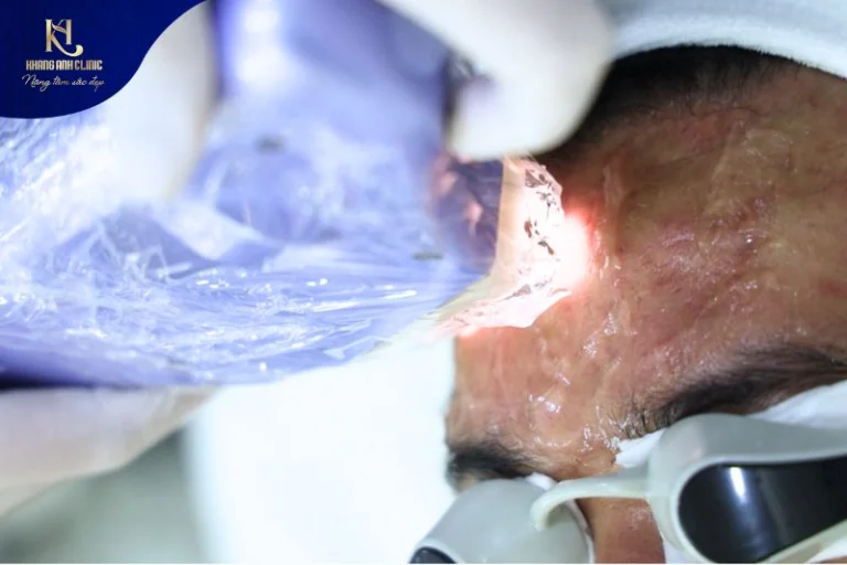 Điều trị mụn Quận 12 tại Phòng khám Khang Anh đem đến hiệu quả cao