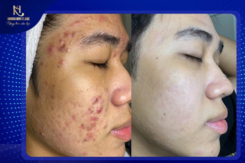 Feedback khách hàng điệu trị mụn tại Khang Anh của Em Duy