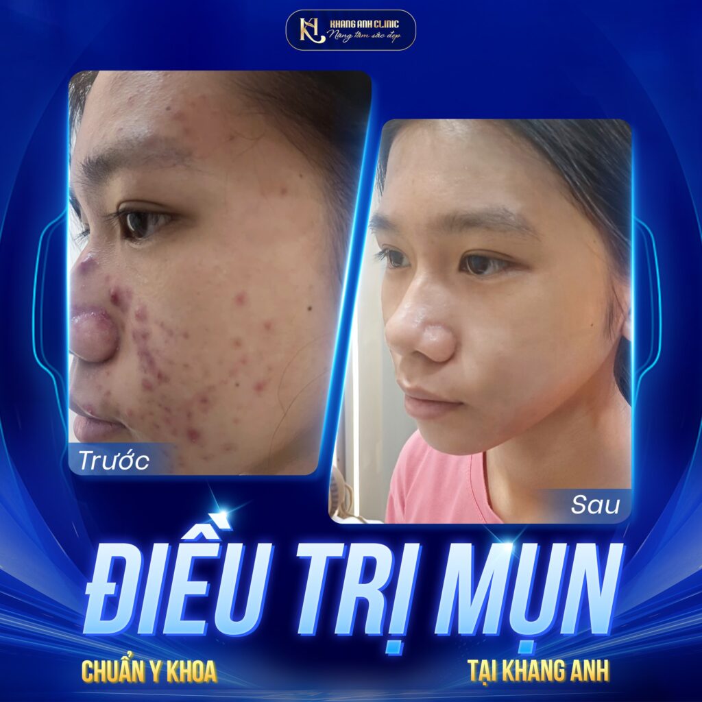 Feedback khách hàng điệu trị mụn tại Khang Anh của Em Thúy