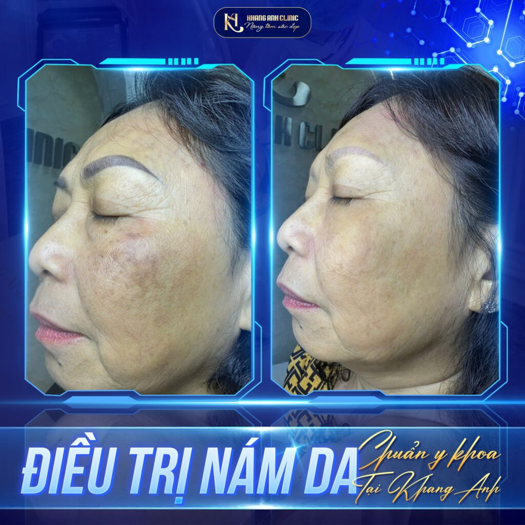 Feedback khách hàng điều trị nám chân sâu ttại Khang Anh
