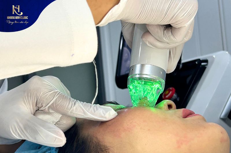 Công nghệ điều trị nám bằng RF Needle tại Phòng khám Quận 12