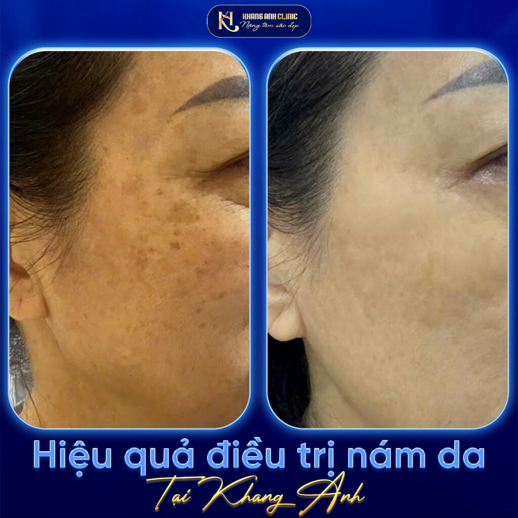 Hiệu quả điều trị điều trị nám chuẩn Y khoa tại Phòng khám Chuyên khoa Da Liễu Khang Anh