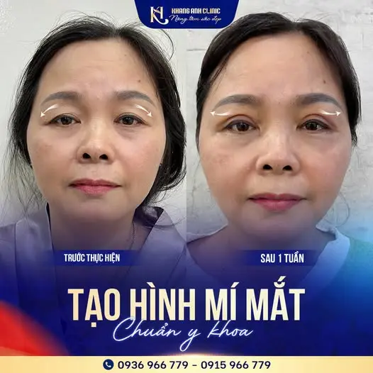 Feedback thực tế khách hàng tạo hình thẩm mỹ tại Phòng khám Khang Anh