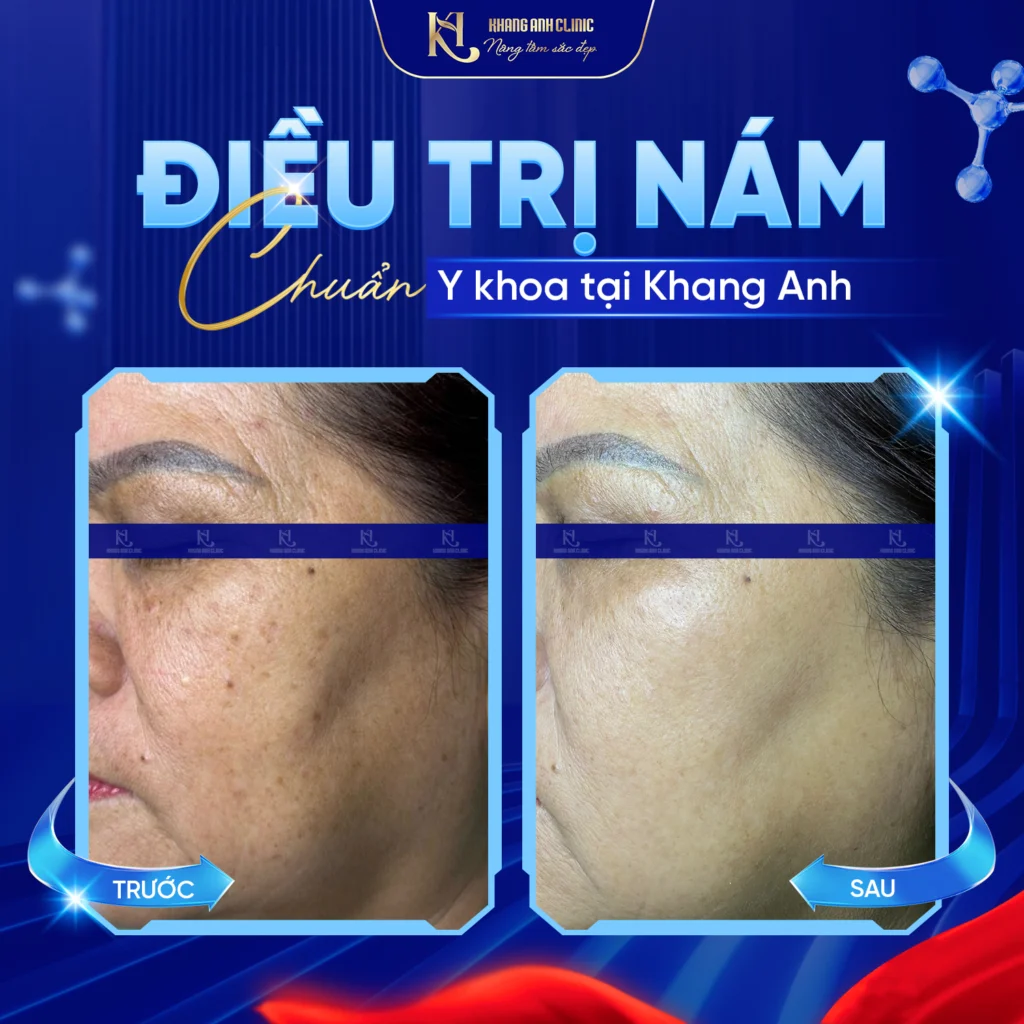Feedbac thực tế khách hàng điều trị nám da tại Phòng khám Khang Anh