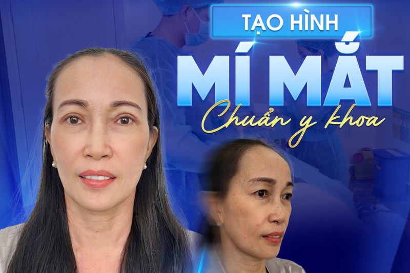 Feedback khách hàng tạo hình mí mắt tại Khang Anh