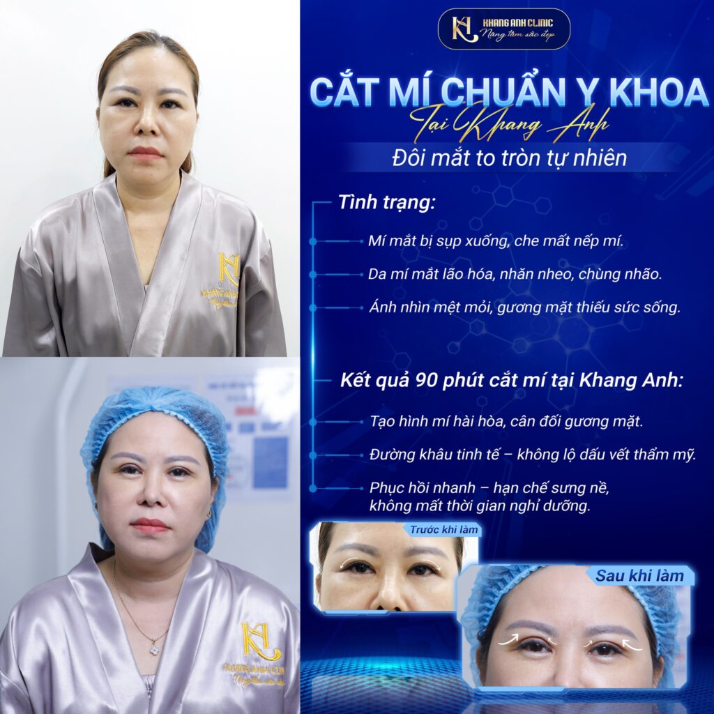 Feedback khách hàng tạo hình mí mắt chuẩn Y khoa tại Khang Anh