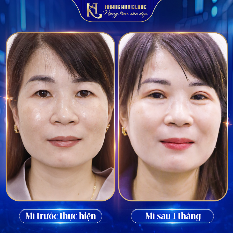 Feedback khách hàng tạo hình thẩm mỹ Quận 12 đem lại hiệu quả tự nhiên