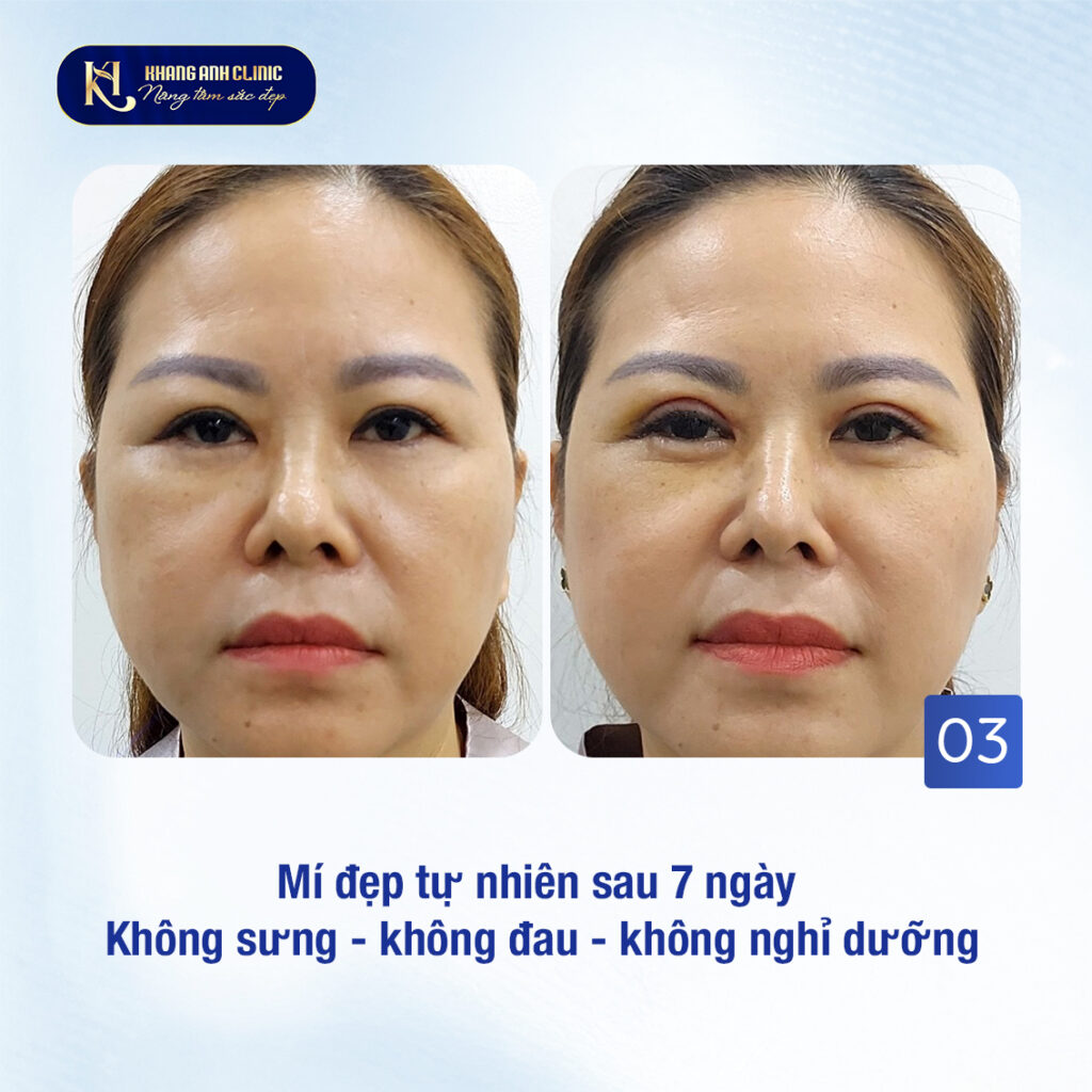 Tạo hình mí mắt chuẩn Y khoa tại Phòng khám Khang Anh