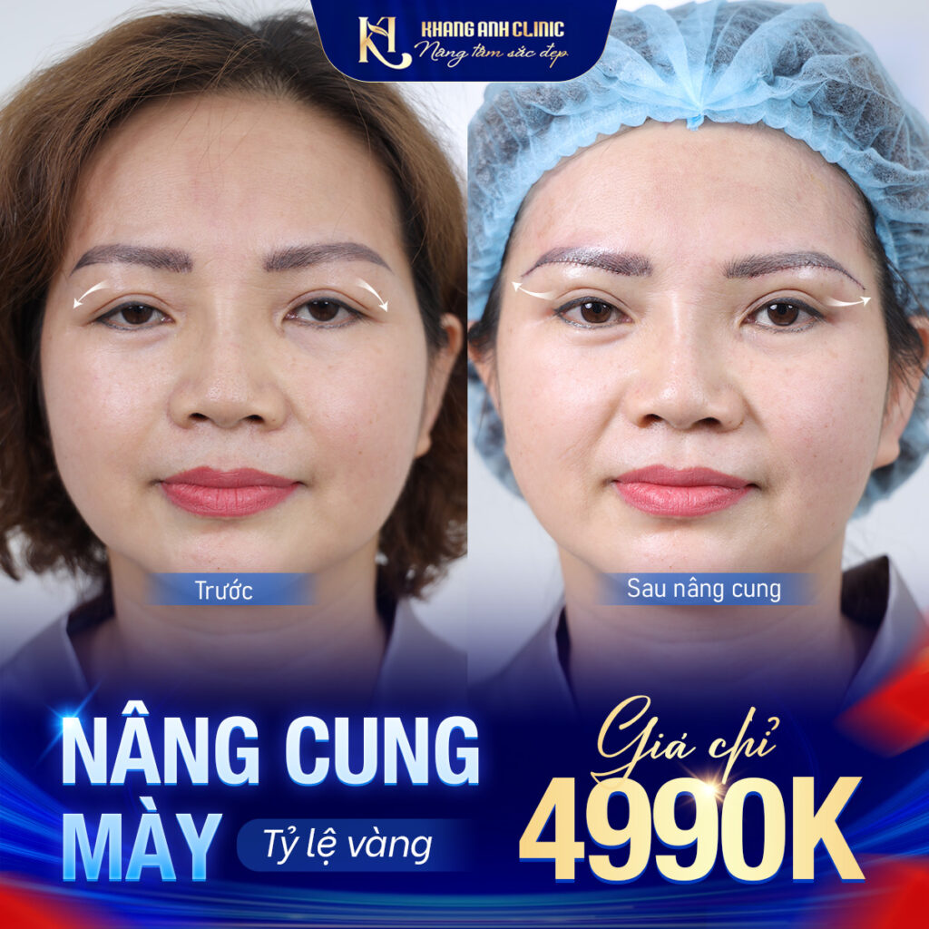 Ưu đãi nâng cung chân mày tại Khang Anh