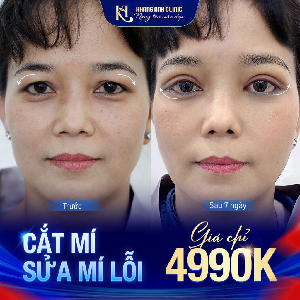 Ưu đãi tạo hình mí mắt tại Khang Anh